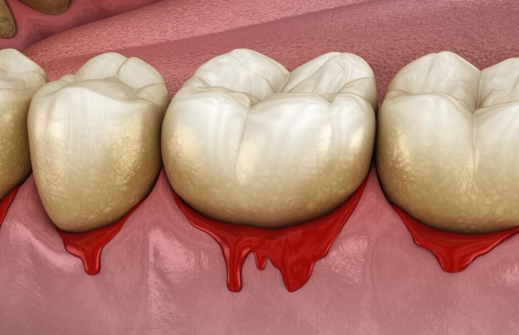 Periodontal Disease Heightens Cancer Risks