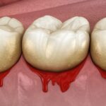 Periodontal Disease Heightens Cancer Risks