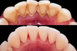 Smile Land Dental Cleaning Before and After